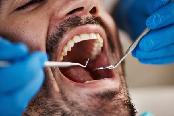 Best Emergency Dental Extractions in Mineola, TX